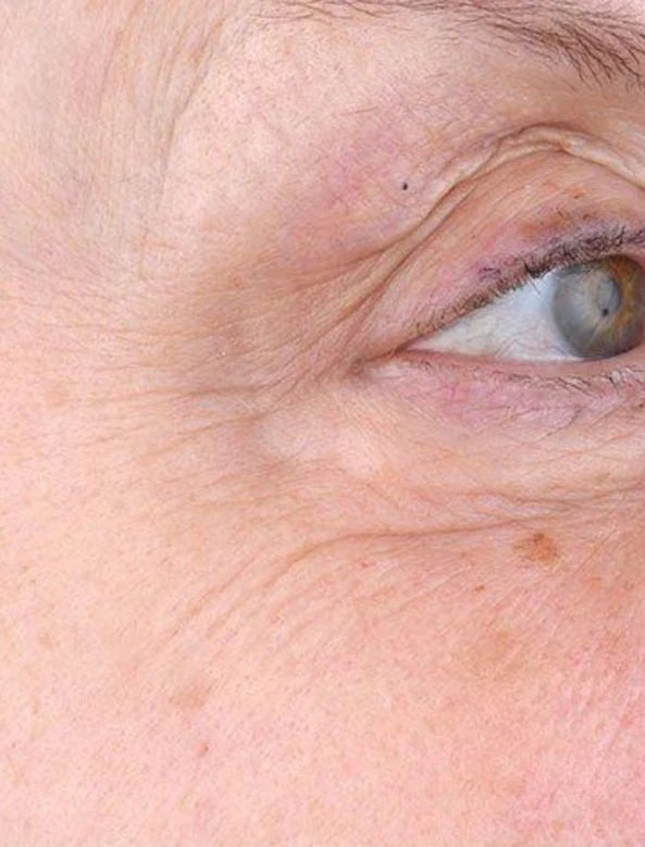 Eye area, before