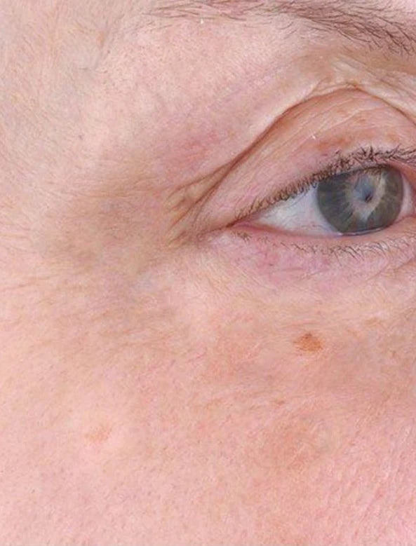 Eye area, after