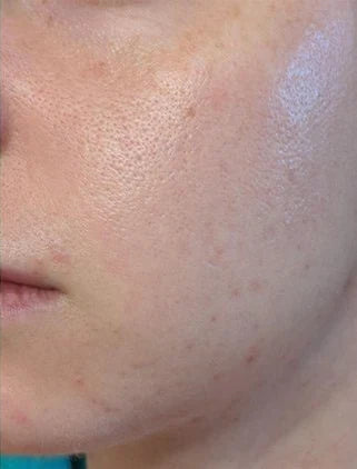 Blemishes, after