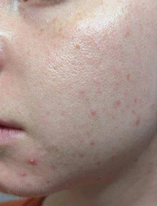 Blemishes, before
