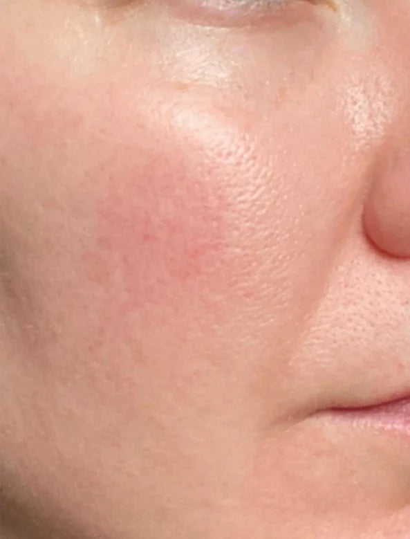 Redness, after
