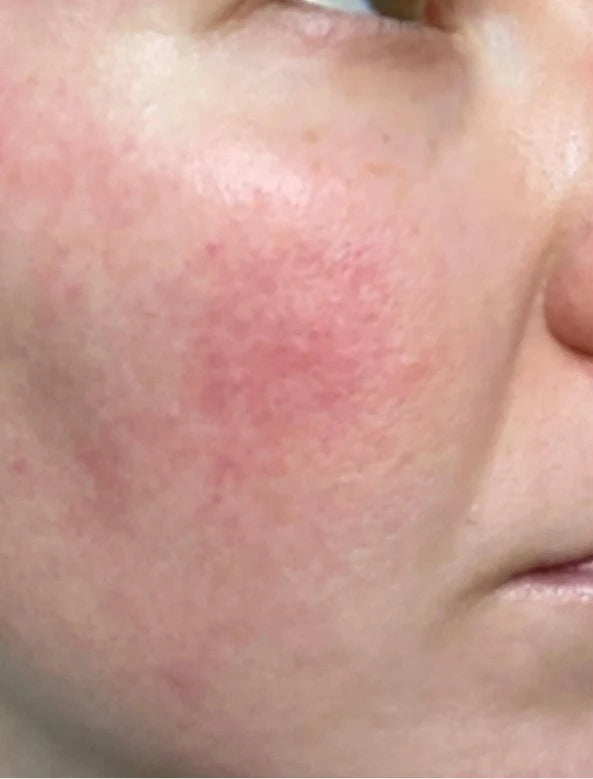 Redness, before