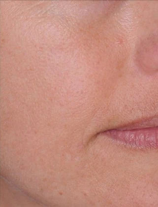 Smile lines, after