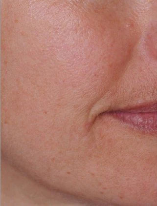 Smile lines, before