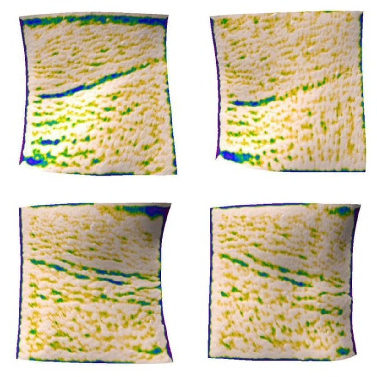 Cartographie 3D de l'affaissement du cou (ANTERA 3D), sujet n°12 : −48,5 % côté appareil + soins, −24,7 % côté soins seuls (moyennes : −32,6 % et −19,5 %). Exemple individuel, les résultats varient.